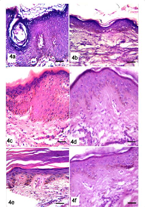 Haematoxylin And Eosin Stained Sections Of Group Seborrheic