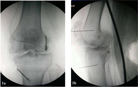 Long Term Efficacy Of Genicular Nerve Ablation For Chronic Osteoarthritic Knee Pain A