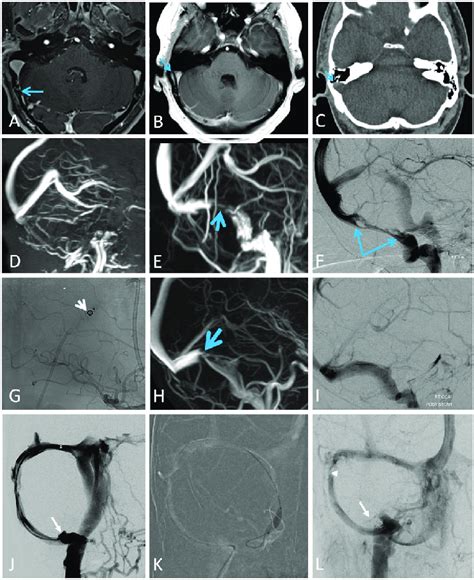 A L Spectrum Of Sinus Stenosis A C High Grade Stenosis A Arrow