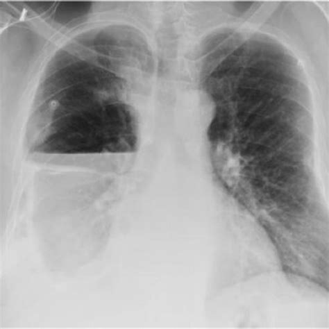 Pleural X Catheter