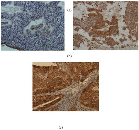 Immunohistochemical Expression Of E Cadherin And N Cadherin In