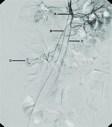 Superior mesenteric artery angiogram delineating the anatomy (A ...