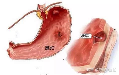 「胃」溃疡与糜烂，傻傻分不清楚 知乎