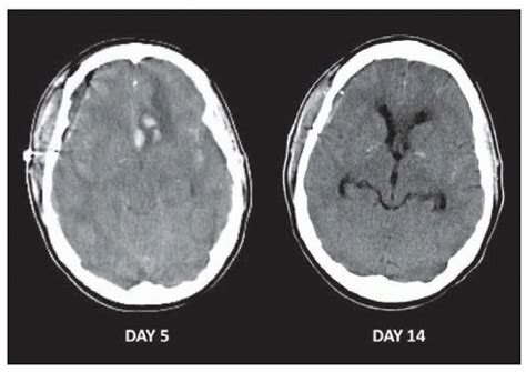 Brain Edema And Disorders Of Intracranial Pressure Neupsy Key