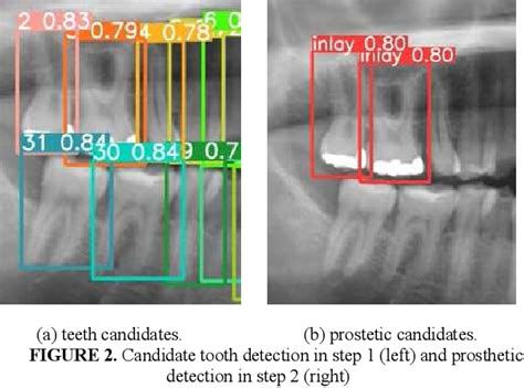 Figure 1 From Tooth Recognition In X Ray Dental Panoramic Images With Prosthetic Detection