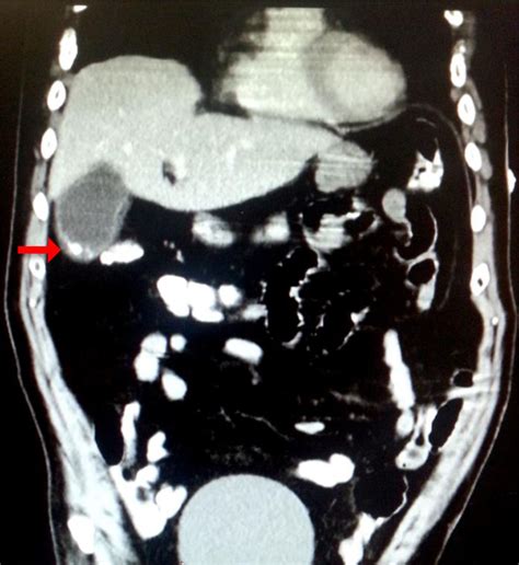 Mural Calcification And Or Stone In The Fundus Of The Gallbladder Red