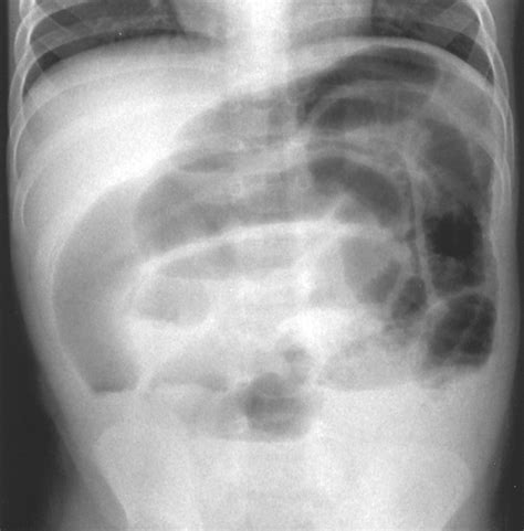 Intussusception The Use Of Delayed Repeated Reduction Attempts And