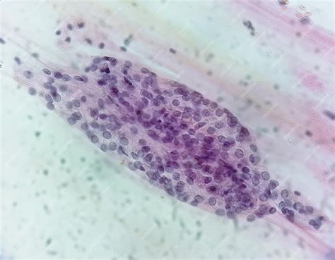 Premium Photo Trichomonas Vaginalis In Pap Smear With Few Acute