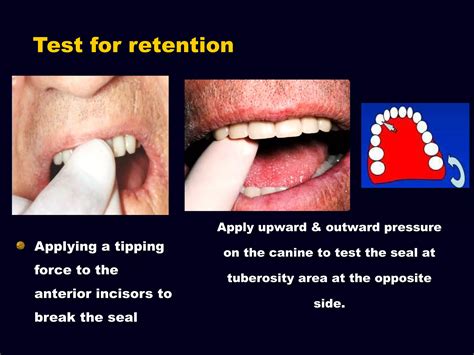 7 Try In Of The Wax Trial Complete Denture Ppt