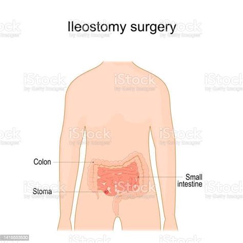 Ileostomy Stoma Surgical Opening Of Small Intestine Stock Illustration