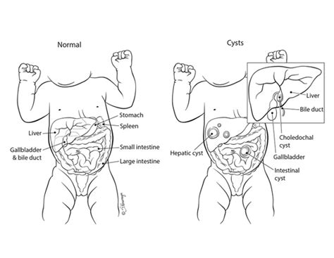 Best mesenteric and omental cyst treatment for Paed in Pakistan