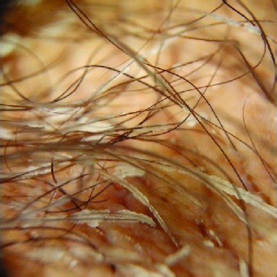 a: Dermatoscopic aspect of axillary hairs surrounded by nodules and ...