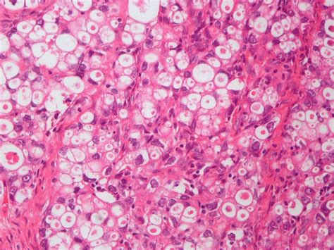 Pathology Outlines Clear Cell Carcinoma