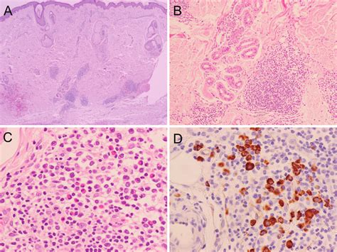 Plasma Cell Vs Lymphocyte