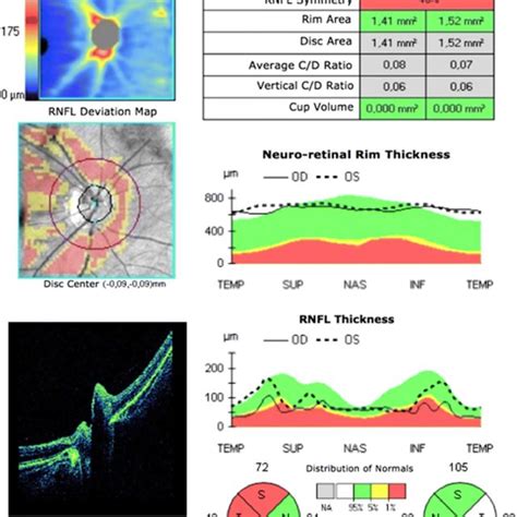 Correlation between inter-eye asymmetry of the RNFL thickness and ...