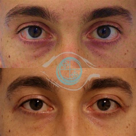 Correction of scleral show with #lateralcanthoplasty to reduce the appearance of a ‘prominent ...