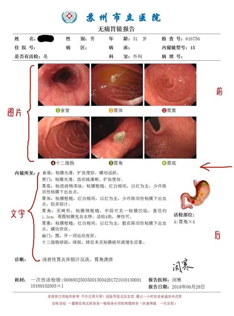 消化科博士教你3分钟看懂胃镜报告 中国医疗