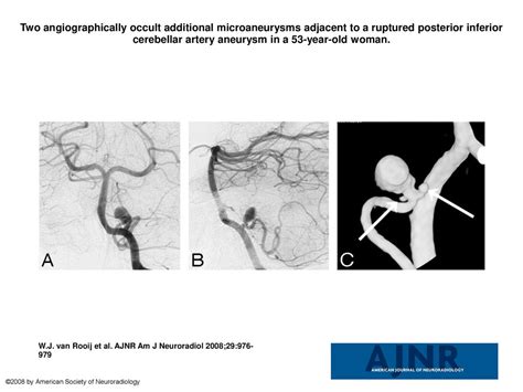 Two angiographically occult additional microaneurysms adjacent to a ...