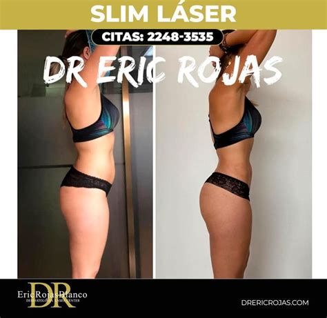 Moldea tu figura con Slim Láser procedimiento exclusivo del Dr Eric