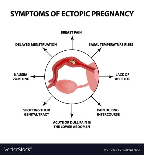 Symptoms of ectopic pregnancy infographics Vector Image