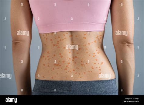 Guttate Psoriasis Pictures Causes Treatment And More 47 Off