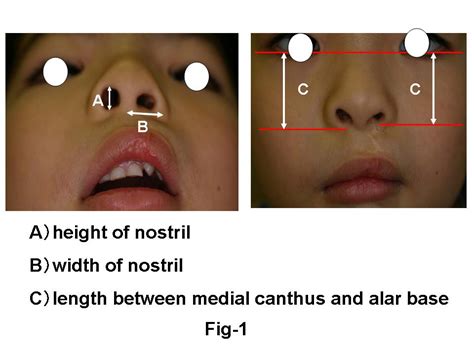 A Modified Reverse U Method For Correction Of Unilateral Cleft Lip Nose