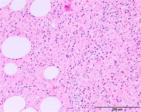 Pathology Outlines Atypical Lipomatous Tumor Well Differentiated