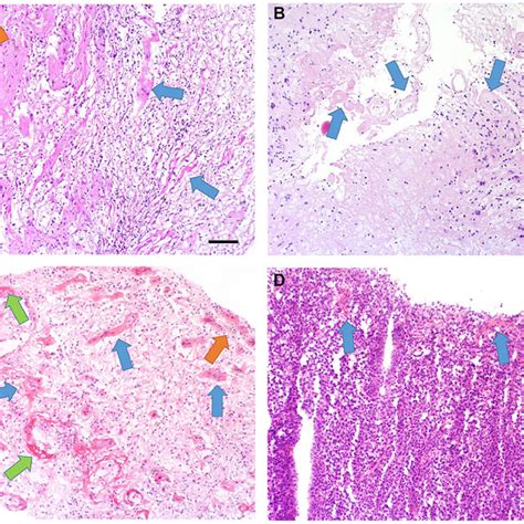 Pathology Results A H E Stained Tissue Sections Of Brain Biopsy Show