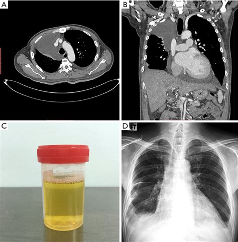 Pleural fluid - wowladeg