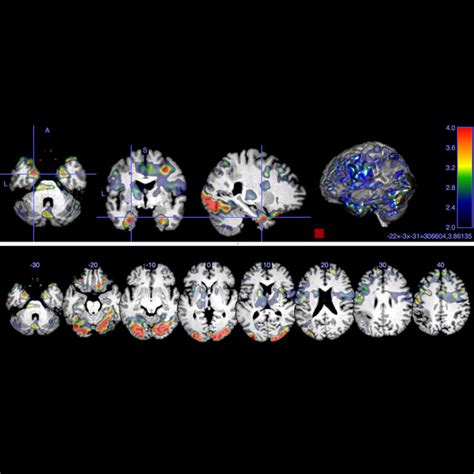 Stimulating Communication In Aphasia Patients Johns Hopkins Medicine