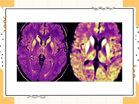 Prion Disease Symptoms Causes Types And Treatment Dr Deepak Agrawal