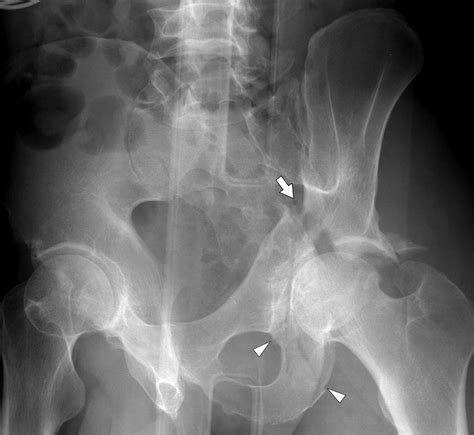 Acetabular Fractures Orthoinfo Aaos