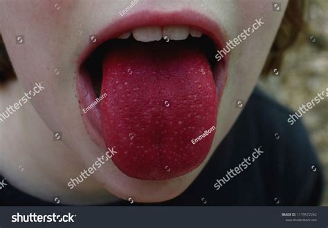 Bright Red Tongue Strawberry Tongue Stock Photo 1179572242 | Shutterstock