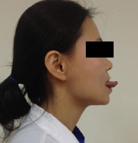 Mendelsohn maneuver. Figure 1. Tongue-holding maneuver. | Download ...