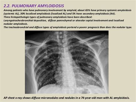 Presentation1 Radiological Imaging Of Amyloidosis