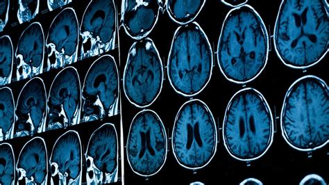 Is it necessary to have a CT scan or an MRI to diagnose migraine ...