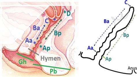 How To Use The Pelvic Organ Prolapse Quantification Pop‐q System Madhu 2018