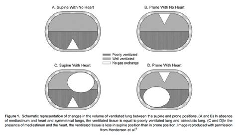 The Essentials Of Prone Position In Acute Respiratory Distress Syndrome