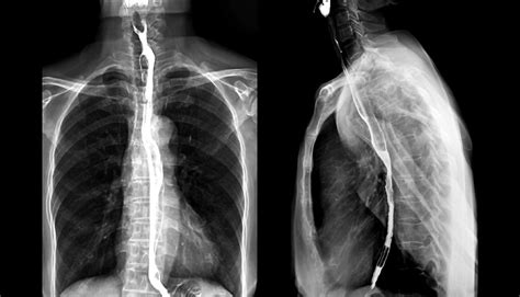 Esophagogastrectomy Moffitt