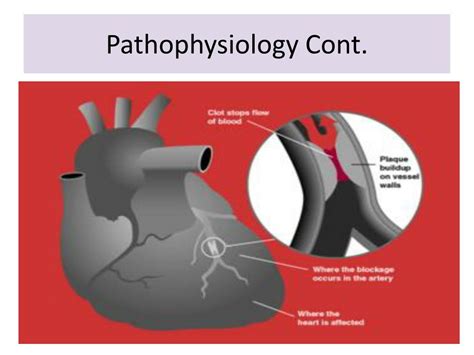 Ppt Myocardial Infarction Powerpoint Presentation Free Download Id