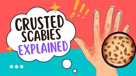 Crusted Scabies Explained Fast Cause And Treatment Youtube