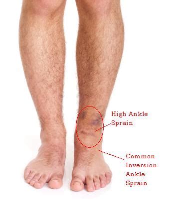 High Ankle Sprain Treatment Burlington Sports Therapy