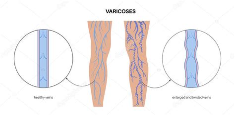 Concepto De Venas Varicosas Hinchaz N Y Dolor En Las Piernas Humanas