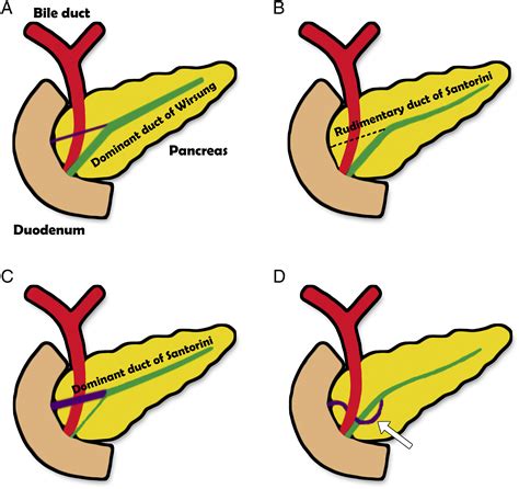 View 15 Pancreas Divisum Types - fronttrendbook