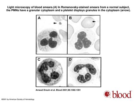 Newly Recognized Cellular Abnormalities In The Gray Platelet Syndrome