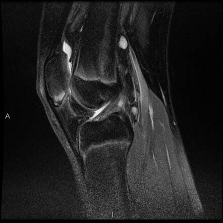 Sinding Larson Johansson Slj Syndrome And Distal Femoral Cortical