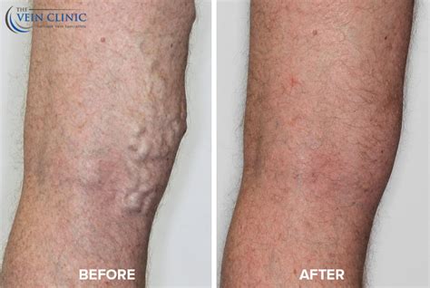 Varicose Vein Treatment Before And After Vein Clinic Subiaco