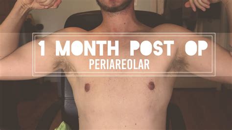 Female To Male 1 Month Post Top Surgery Periareolar Youtube