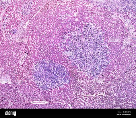 Human Liver Carcinoma Light Micrograph Stock Photo Alamy