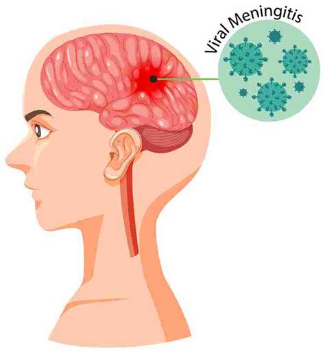 Meningitis In Adults Know The Symptoms Causes And Treatment